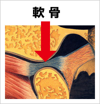 “軟骨”のズレが原因で痛みを発症